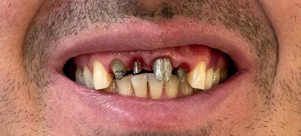 Caso 4 — antes