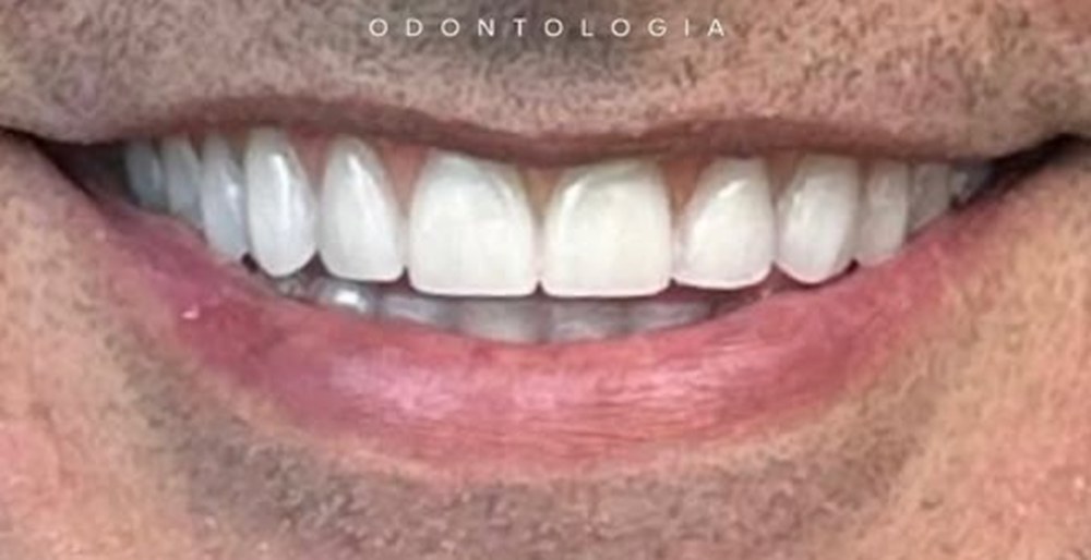 Caso 8 — depois