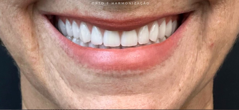 Caso 9 — depois